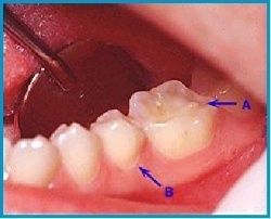 Reflü ve dişlerde aşınma